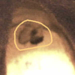 Inside the right boot, the hole in the inner sole